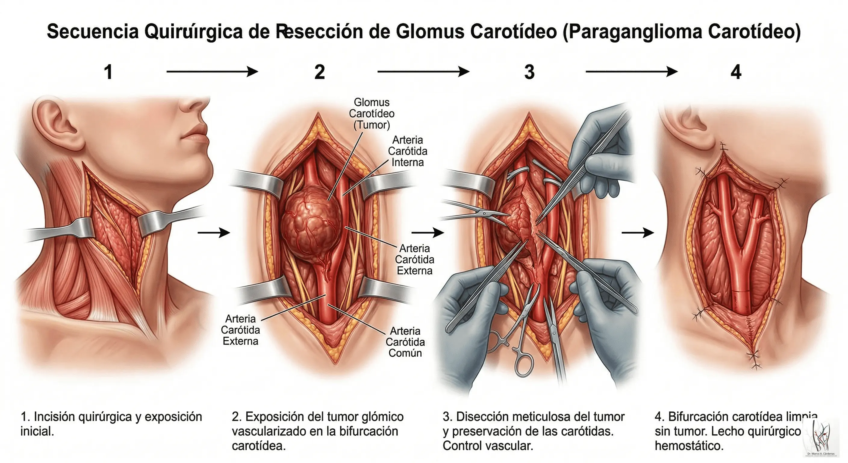 Resección de Glomus